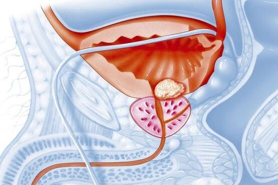 Processus inflammatoire dans la prostate