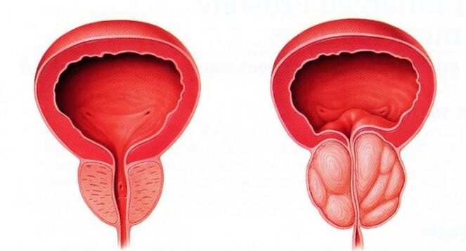 Prostate saine et enflammée avec prostatite chronique.