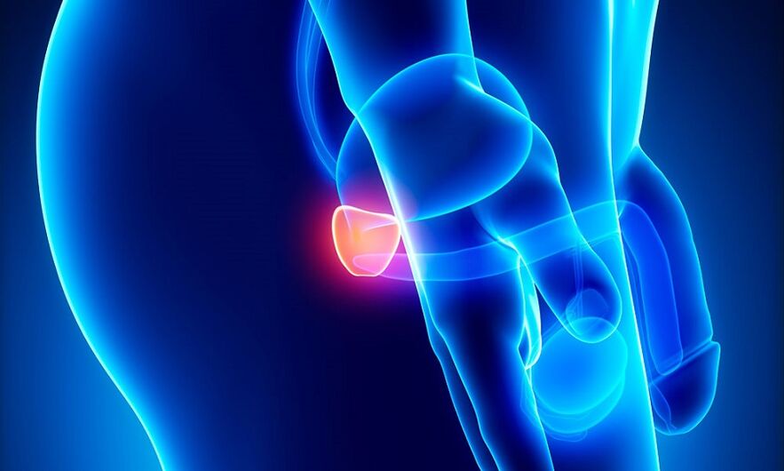 Inflammation de la prostate avec la prostatite