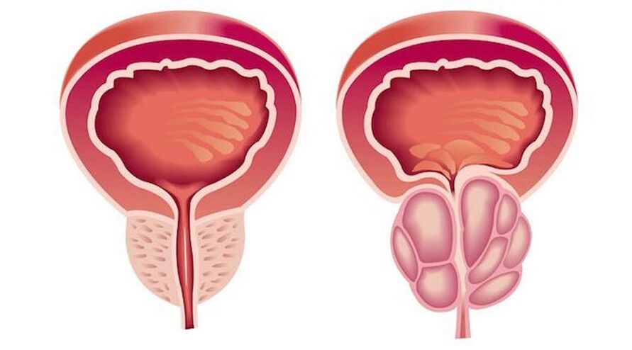 Prostate saine et enflammée avec prostatite