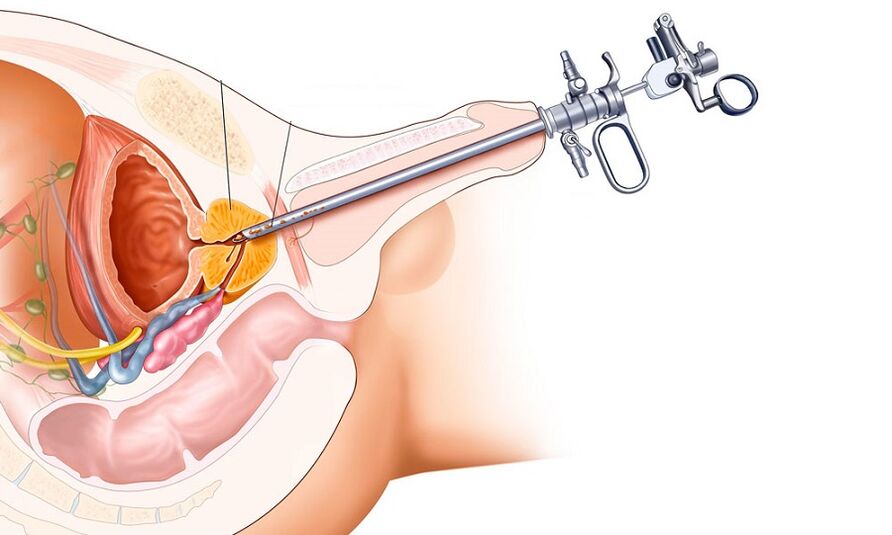 Traitement chirurgical de la prostatite